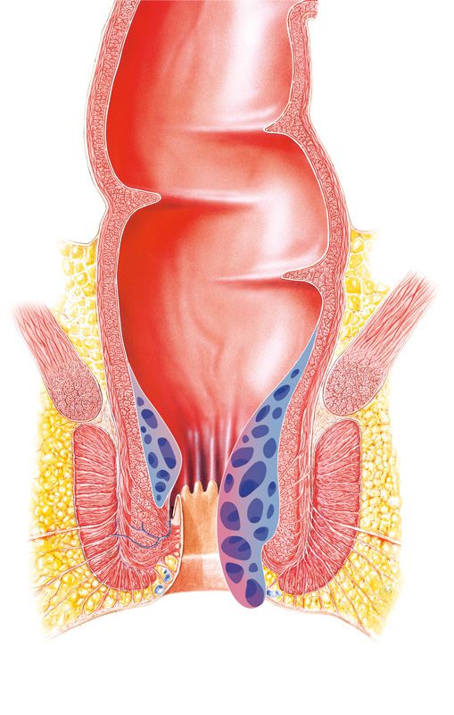 haemorrhoiden 3