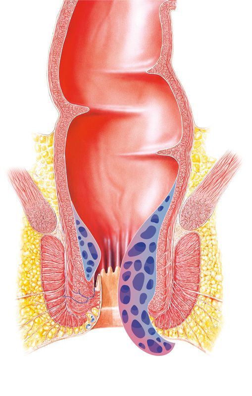 haemorrhoiden 4